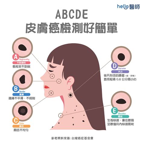 臉突然長痣|突然長痣是罹皮膚癌？醫揭「5徵兆」快就醫檢查：1時段最好別出。